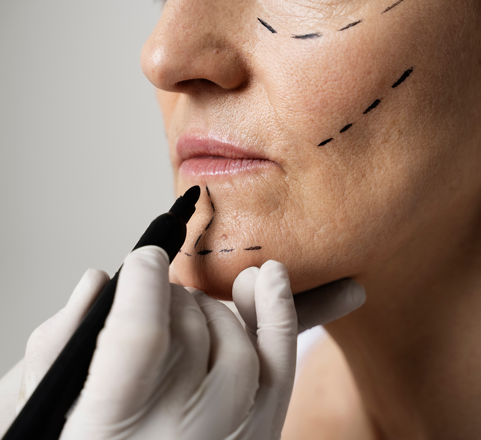 تقشير كيميائي بأحماض طبية