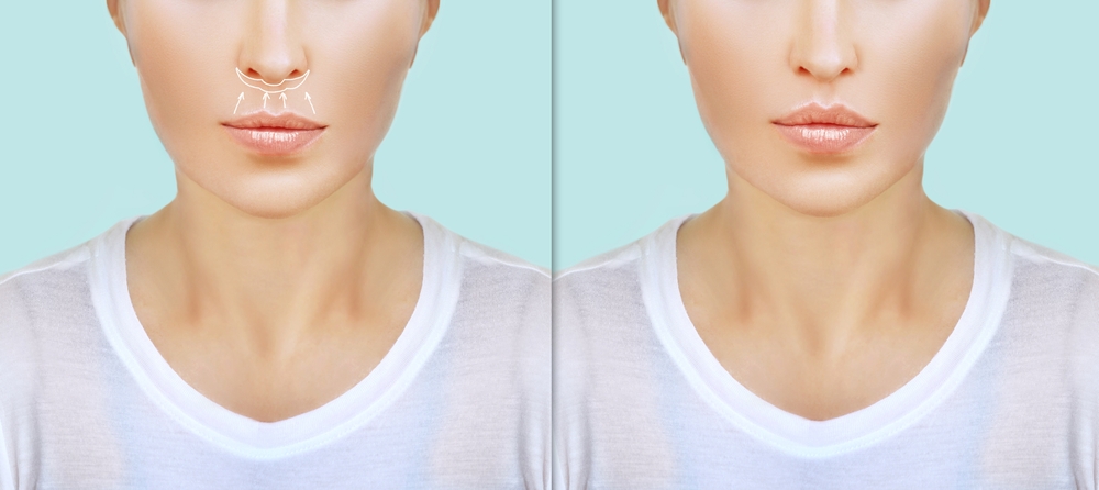 عملية تصغير المسافة بين الأنف والشفة